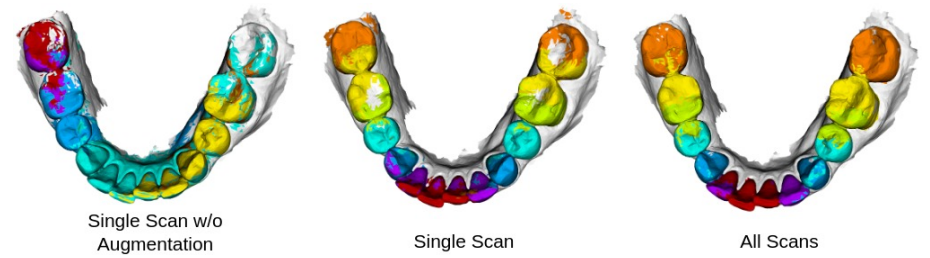 Single Tooth